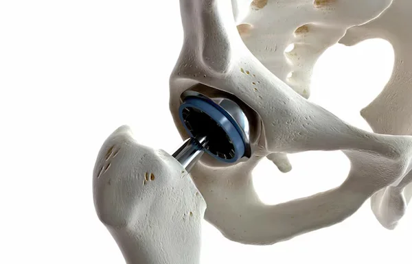 Hip Replacement Surgery